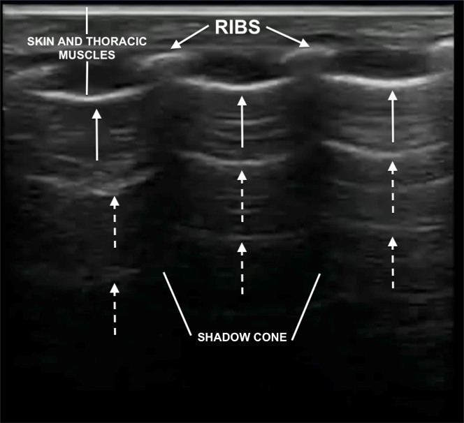 POCUS Lung | NicuPocus